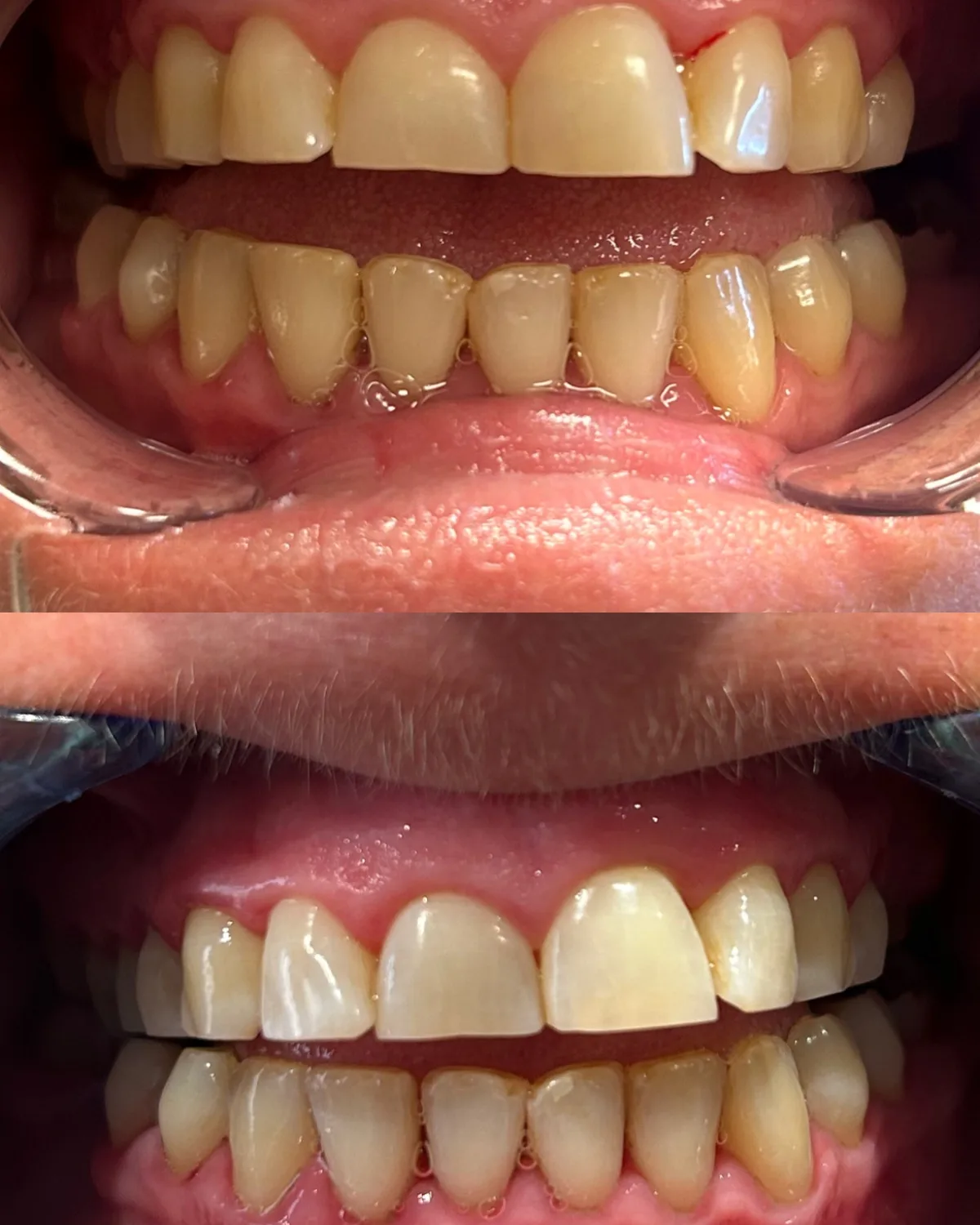 Bronze & Beauty resultaat